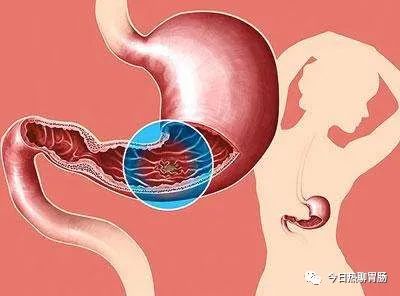十二指肠溃疡久拖不治，会带来哪些危害？别不当回事