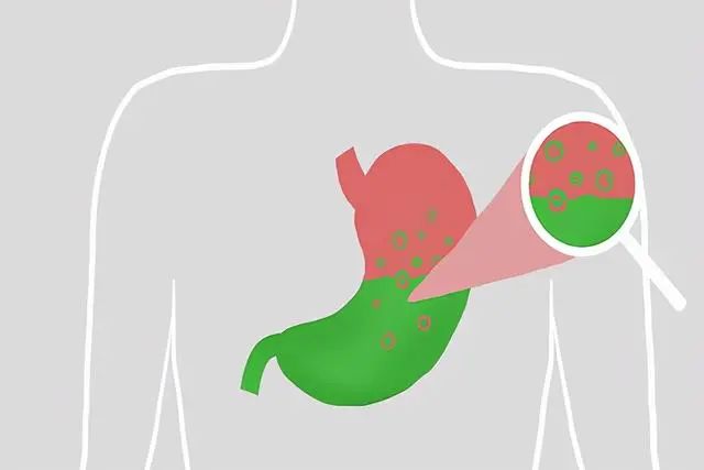 经常反酸、烧心怎么保养？做好5件事，控制好反流性食管炎