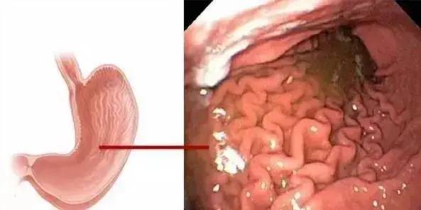 胃镜只是检查胃吗？一组图片告诉你胃镜多厉害！