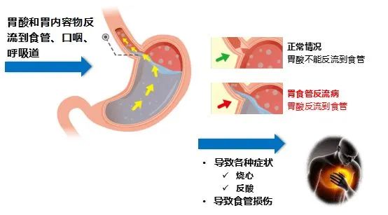 饭后“烧心”是怎么回事？这不是小事可能隐藏大问题！