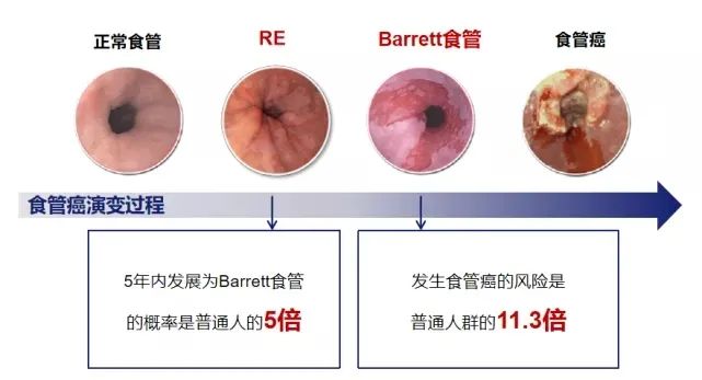 饭后“烧心”是怎么回事？这不是小事可能隐藏大问题！