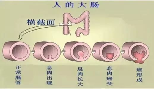 为啥会长胃肠息肉？都有啥危害？怎么预防和治疗？