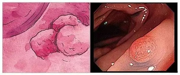 如果每年都做肠镜，发现息肉就处理，是不是得结肠癌的可能不大？