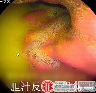 胆汁反流性胃炎——全科普