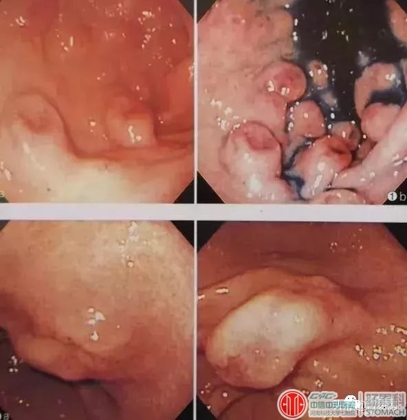 消化科医生提醒这种糜烂性胃炎是癌前病变