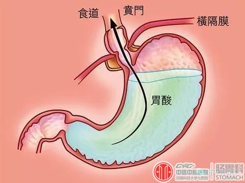 消化科医生提醒：这3个信号是胃癌，不是胃炎！早发现可保命