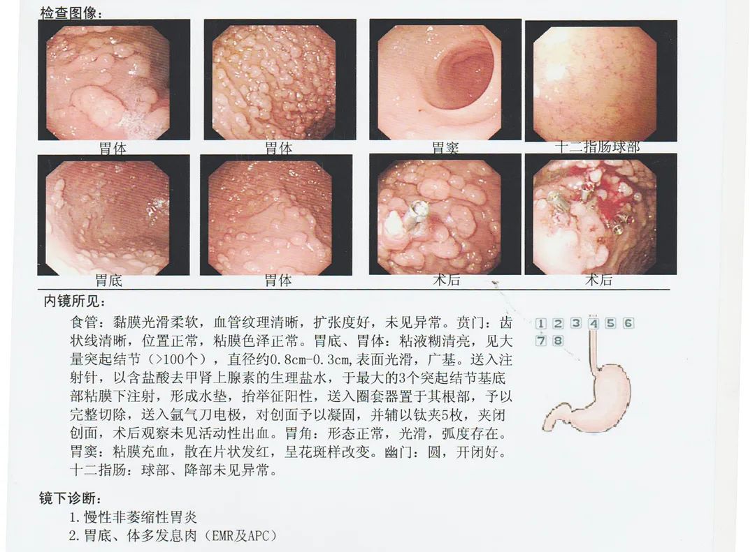 惊！35岁女性患者胃内密密麻麻长了100多枚息肉……