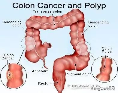 肠息肉是大肠癌的前身，有办法预防吗？