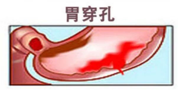 胃出血合并胃穿孔怎么办