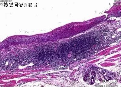 嗓子干痒、有异物感，别以为只是得了咽炎！