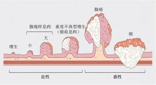 导致直肠癌五个常见风险