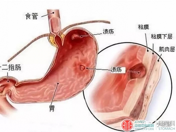 十二指肠溃疡是怎么引起的？这5大诱因是元凶！