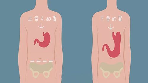 胃下垂保健方法