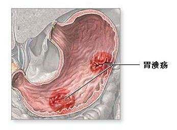 糜烂性胃炎形成的几种危害，你知道几种？