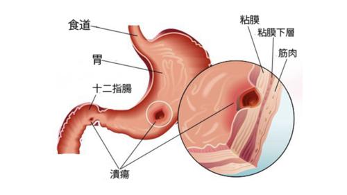 非溃疡消化不良有哪些饮食禁忌 怎样治疗非溃疡消化不良