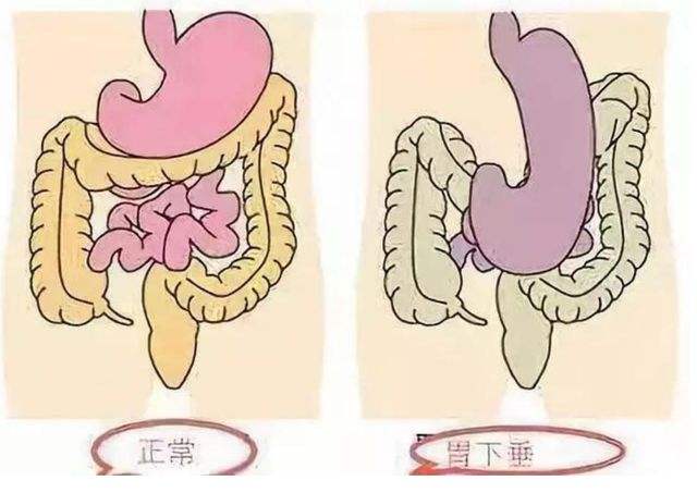 胃溃疡的发生部分