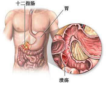 如何打好保胃战 赶走胃溃疡