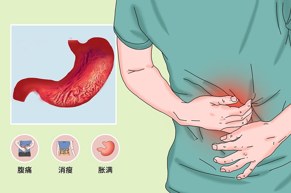 胃溃疡临床症状