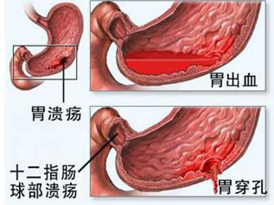 如何打好保胃战 赶走胃溃疡