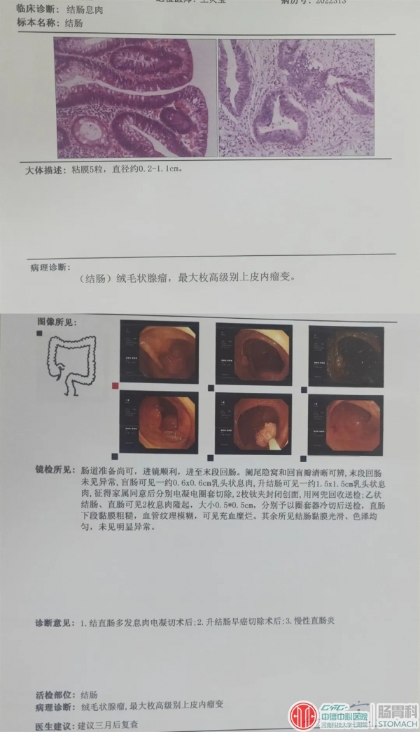 发现一例早癌，挽救一个家庭，胃肠镜检查—消化道癌的“排雷手”