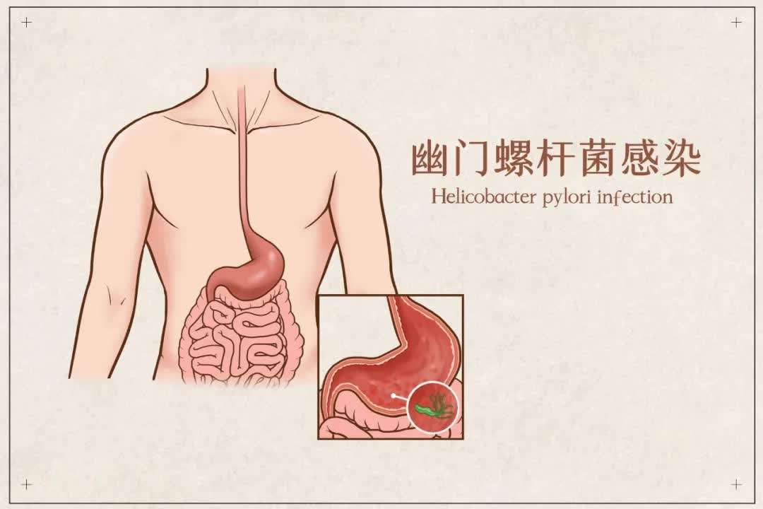 胃溃疡为一综合因素所致。