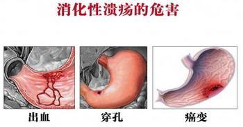 胃溃疡性穿孔的症状有哪些