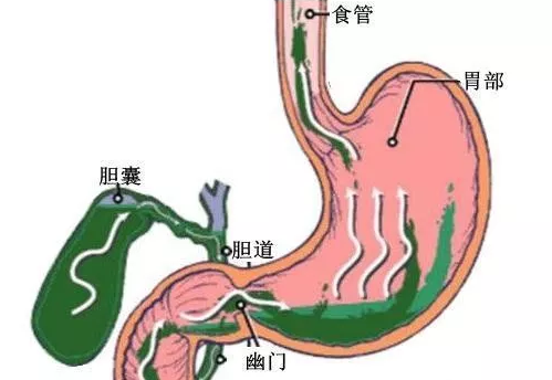 胆汁返流性胃炎为什么会造成喉炎? 胆汁返流性胃炎怎么治疗?