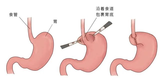 胃食管反流擅长“伪装”，常常潜伏在这8个科室