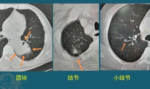 韭菜是结节的“加速剂”吗？消化科主任：不想结节恶化，少吃7物