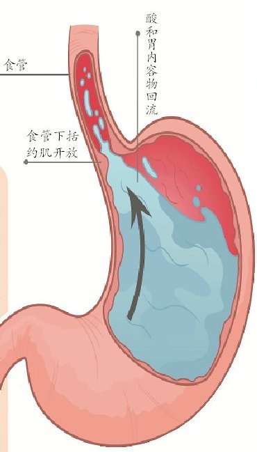 反酸、烧心并不一定是普通胃病！这种病极易被误诊