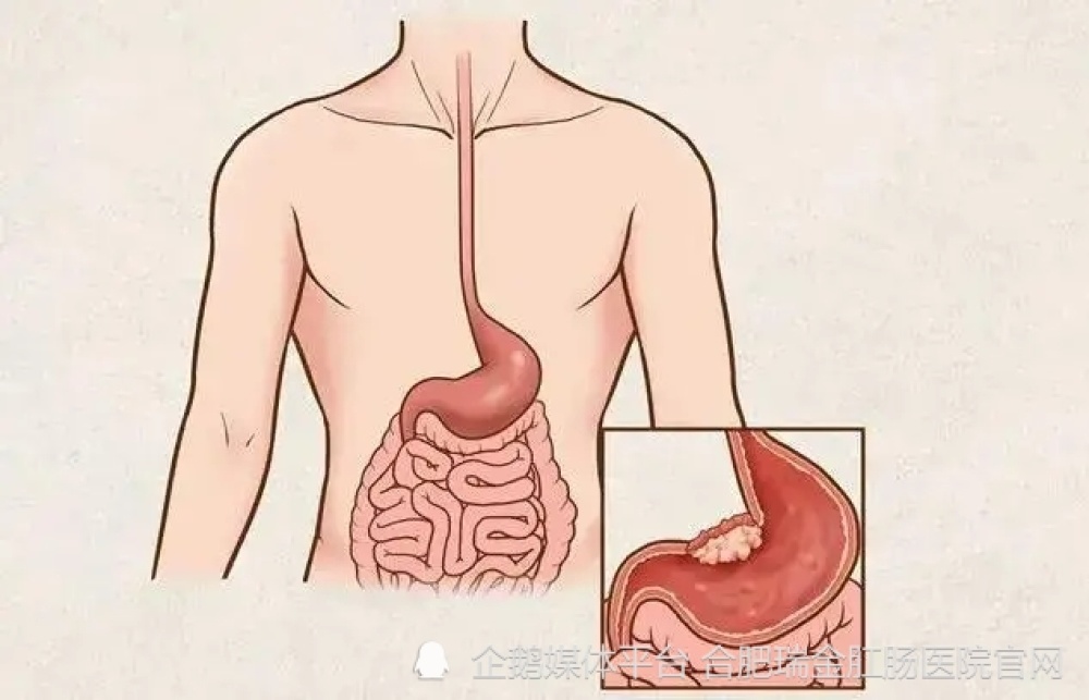 胃胀气有哪些症状？合肥瑞金肛肠医院告诉你