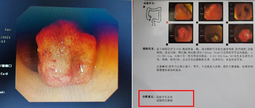 微创外科丨治痔疮却意外查出直肠癌！大便带血需警惕！