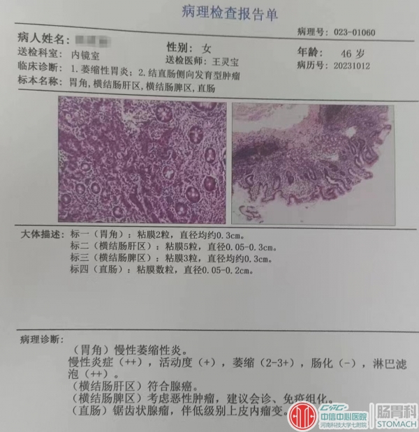 结肠镜，40岁需要做，45岁应该做，50岁必须做