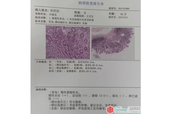 结肠镜，40岁需要做，45岁应该做，50岁必须做