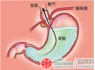 胃食管反流很难受？这5个方法帮你快速缓解！