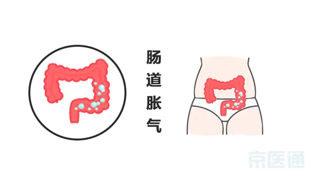 医生教你两个动作缓解胃肠胀气