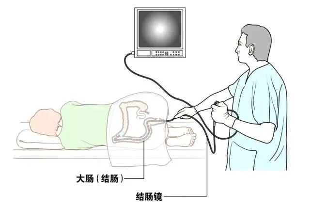 讲讲胃/肠镜检查详细攻略