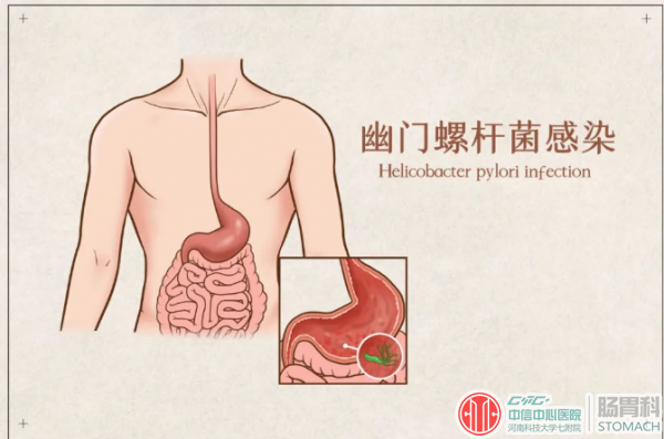 慢性萎缩性胃炎能彻底治愈吗