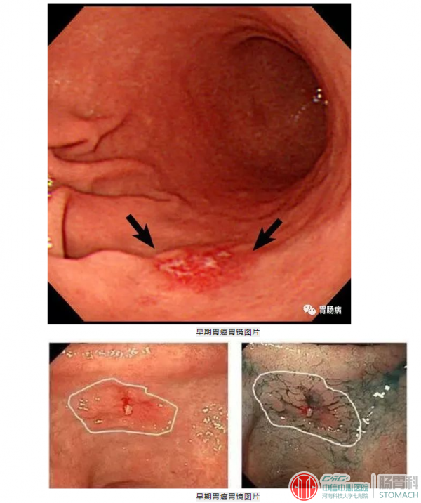 胃癌的“早期症状”，就是没有症状，有症状的已经不早了！