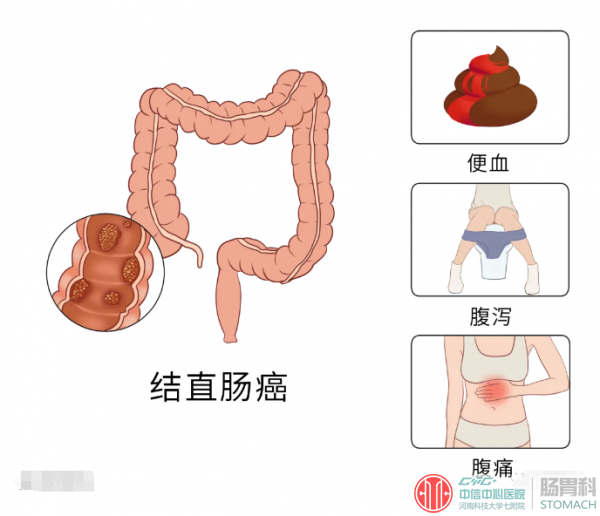 患者自述：女，37岁，2个女儿，结婚10周年纪念日，查出肠癌