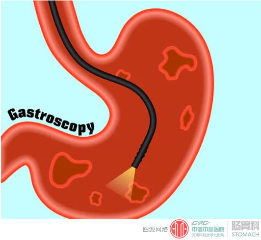 做过胃镜的人都感同身受：一查就看出来这几种病