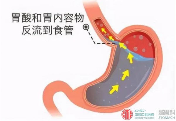 饭后反酸、烧心？或是反流性食管炎，哪些症状预示你患了反流性食管炎