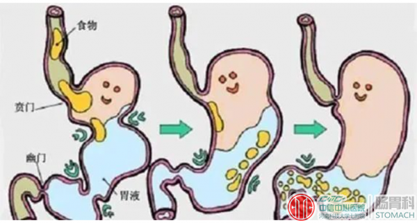 反流性胃炎，可能是最痛不欲生的胃病，这三招教你减轻痛苦