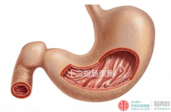 空腹痛、餐后痛，要小心消化性溃疡！