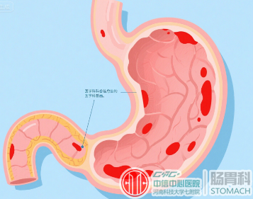 胃炎能不能吃鱼？若想让胃舒服些，建议少吃3种食物